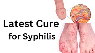 Latest treatment of syphilis How to cure any stage of syphilis [upl. by Petula414]