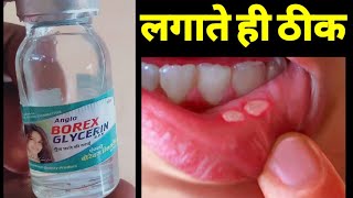 Borex glycerine glycerin Gulaaljal ke fayde use for ulser [upl. by Melanie362]