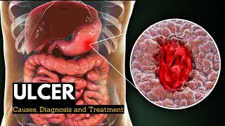 Ulcer Causes Signs and Symptoms Diagnosis and Treatment [upl. by Laynad]