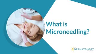 What is Microneedling  Microneedling Treatment [upl. by Cir]