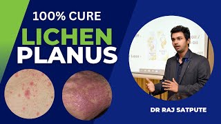 Lichen Planus Pigmentosus  ONLY CURE IN AYURVEDA 100 Lichen Planus Treatment [upl. by Alvie]