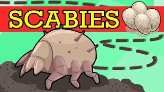 SCABIES Causes Signs and Symptoms Diagnosis and Treatment [upl. by Ameh178]