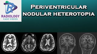 Periventricular nodular heterotopia [upl. by Daye]