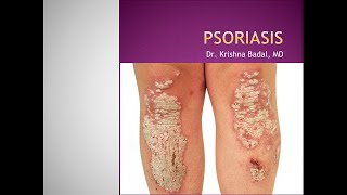 Psoriasis [upl. by Paschasia]