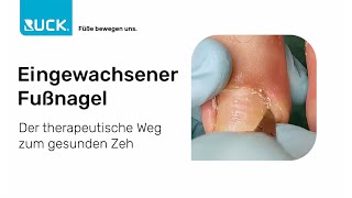 Eingewachsener Fußnagel  der therapeutische Weg zum gesunden Zeh [upl. by Duffy]