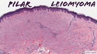 Leiomyoma Pilar Type Piloleiomyoma 5Minute Pathology Pearls [upl. by Tabber]