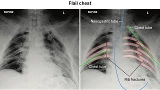 USMLE S2CK Uworld Surgerycase no 1 Flail chest [upl. by Notsirb]