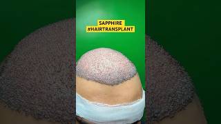 Hair Loss Treatment hair hairloss hairlosstreatment ytshorts alopecia hairtransplant hairfall [upl. by Gunar995]