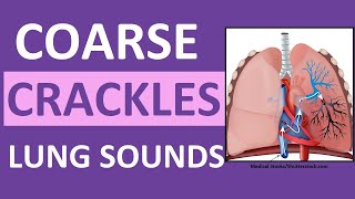 Crackles Coarse Lung Sounds  Crackles and Rales Breath Sounds Abnormal [upl. by Ohcamac]