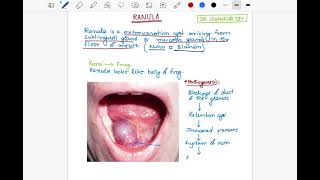 Ranula  Etiology Clinical Features amp Treatment  Surgery  Dr Shankar Dey [upl. by Ortrud504]