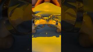 The cementation process for two porcelain veneers veneers veneers cosmeticdentistry [upl. by Mide]