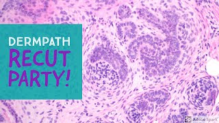 Recut Party Dermatopathology Random Case Review [upl. by Cymbre453]