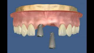 IMPLANT ET INCISIVE [upl. by Notlad]