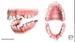 Crowding with Protruding Teeth Extractions [upl. by Ostap96]