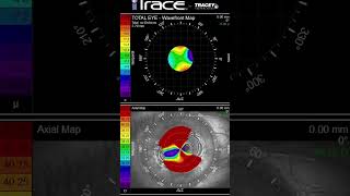 Radial Keratotomy with Over 12 Diopters of Irregular Astigmatism amp the Daytona Race Track 🏎️ [upl. by Gnap]