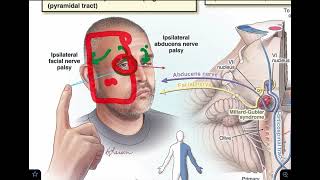 Millard Gubler syndrome  Ventral pontine syndrome  made super easy [upl. by Conlin508]