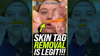 Skin Tag Removal is LEGIT 😱 shorts [upl. by Crofoot]