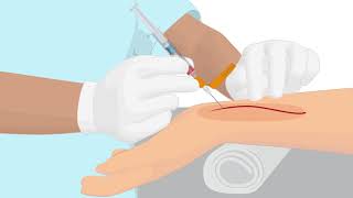 How to properly handle an arterial puncture blood gas sample [upl. by Barbour428]