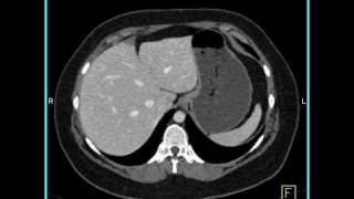 Abdomen Liver Focal Nodular Hyperplasia CT Angiography5 of 6 [upl. by Bowlds734]