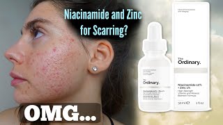 I TESTED THE ORDINARY NIACINAMIDE AND ZINC SERUM FOR MY ACNE SCARS ONE MONTH Shocked by this [upl. by Idnod]