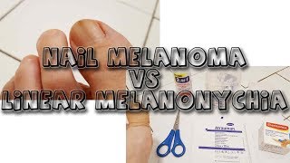 Nail Melanoma VS Melanonychia  learn from my story [upl. by Modesta]