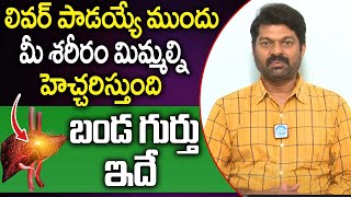 లివర్ పాడయ్యే ముందు బండ గుర్తు ఇదే  Liver Failure Symptoms  Dr Somashakar  idreamhealthtips [upl. by Sleinad]