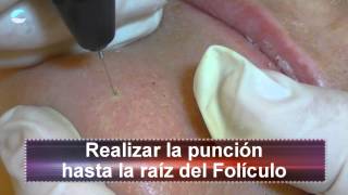 Hirsutismo Vello Facial con Plasmalaser SCORPION [upl. by Kathie]