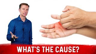 What Causes Sweaty  Dry Hands amp How To Get Rid Of It – Dr Berg [upl. by Naivat914]