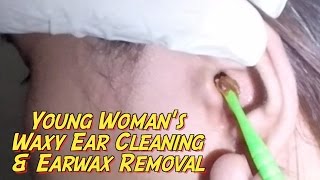 Young Womans Waxy Ear Cleaning amp Earwax Removal [upl. by Namajneb200]