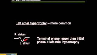 1215 Lead ECG Atrial Hypertrophy [upl. by Hoffert]