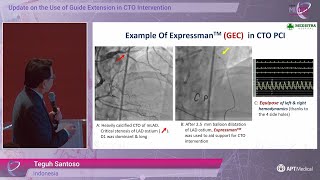 Update on the Use of Guide Extension in CTO Intervention  Dr Teguh Santoso [upl. by Constantia928]