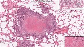 Tuberculosis Granulomas  Histopathology slides [upl. by Sherard41]