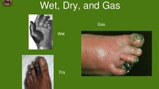 gangrene dry  wet  gas gangrene pathology [upl. by Aical]