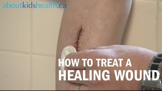 How to care for a healing wound  AboutKidsHealth at The Hospital for Sick Children [upl. by Donell]