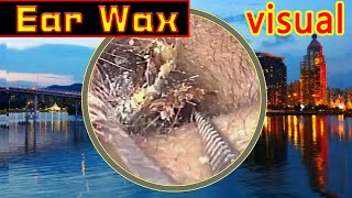 Ear wax removal amp Ear Cleaning （4） [upl. by Croom]