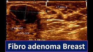 Fibroadenoma Breast Breast Lump  Brest ultrasonogram [upl. by Jarl]