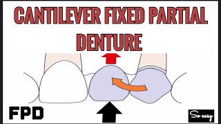 CANTILEVER FIXED PARTIAL DENTURE  TYPE OF FPD  PROSTHODONTICS [upl. by Lleraj]