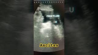 Ascites ultrasound abdomen ascites medical study shortfeed shortsviral hepatitisc ytviral [upl. by Carrillo873]