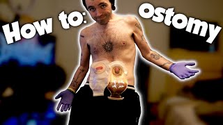 CHANGING MY OSTOMY BAG [upl. by Ahsinroc]