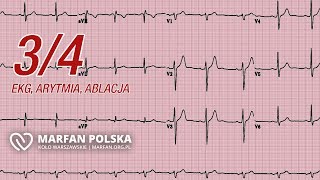 Co to jest ablacja Jak poradzić sobie z arytmią Czym jest EKG [upl. by Yeorgi933]