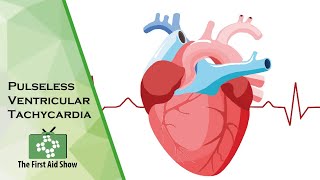 Pulseless Ventricular Tachycardia [upl. by Nonnah632]