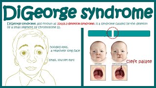 DiGeorge syndrome  22q11 2 deletion syndrome  Immunodeficiency [upl. by Llenahs]