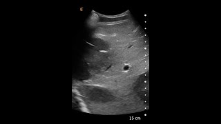 Liver Metastases – Ultrasound Image Interpretation [upl. by Liamsi]