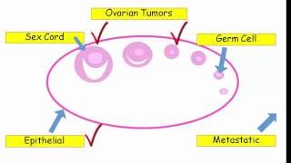 12DaysinMarch Ovarian Tumors for USMLE Step One [upl. by Reinar576]