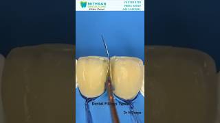 Types of Dental Fillings mithrandental chennai adyar dentalfillings oralhealth doctor [upl. by Hardwick327]