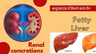 Fatty Liver and Renal Concretions। Common finding in Ultrasound। यकृत में चर्बी एवं वृक्क में रेत [upl. by Mae249]