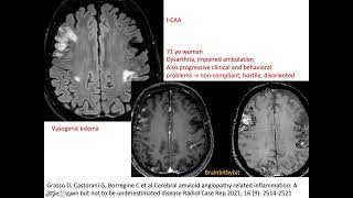 69 ICAA and ABRA CAA related inflammation amyloid beta related angiitis encephalopathy elderly [upl. by Merralee]