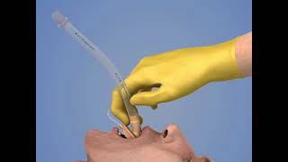 Laryngeal Mask Airway Insertion [upl. by Wyon]