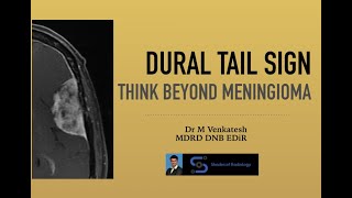 Dural tail sign Think Beyond Meningioma [upl. by Sumerlin2]