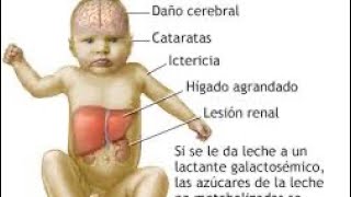 Exposición Oral sobre la Galactosemia [upl. by Novhaj]